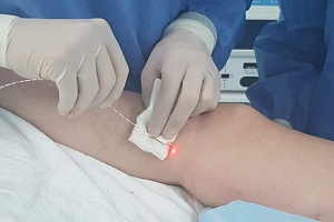 Эндовенозная лазерная коагуляция